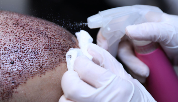 Hair transplant 